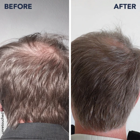 PHYTOPHANERE PACK TRATAMIENTO CABELLO Y UÑAS 2 X 120 CÁPSULAS 4 MESES