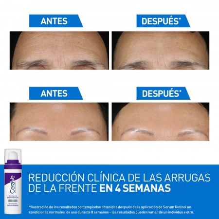 Eficacia clínica de CeraVe serum retinol en la reducción de arrugas de la frente tras un mes
