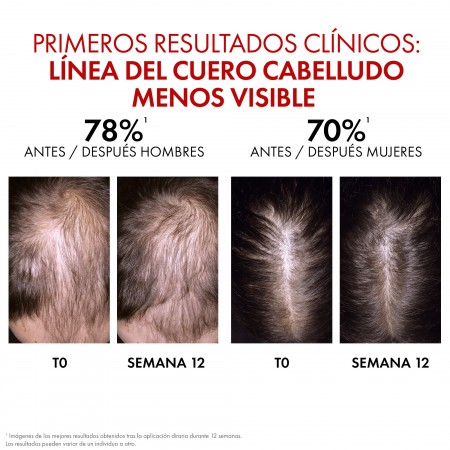 Resultados clínicos a las 12 semanas en cobertura y densidad del cuero cabelludo Vichy Dercos Aminexil Clinical
